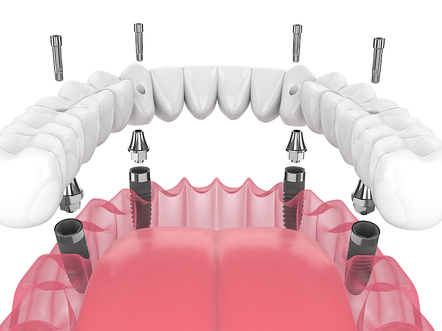 Regain Your Smile with All-on-4 in Hattiesburg, MS, and Laurel, MS