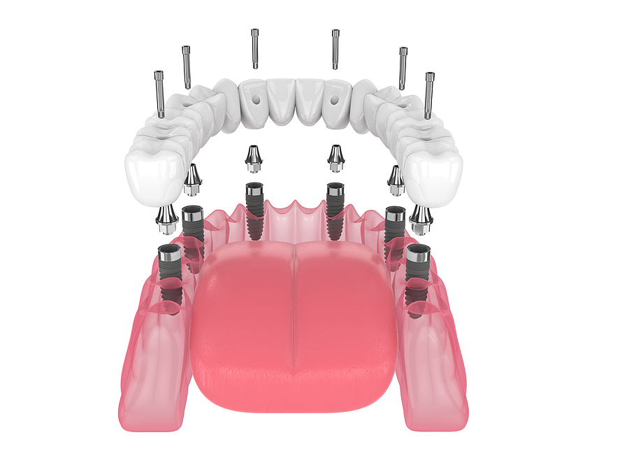 Achieve a Stronger, More Stable Smile with All-on-6 in Hattiesburg, MS, and Laurel, MS