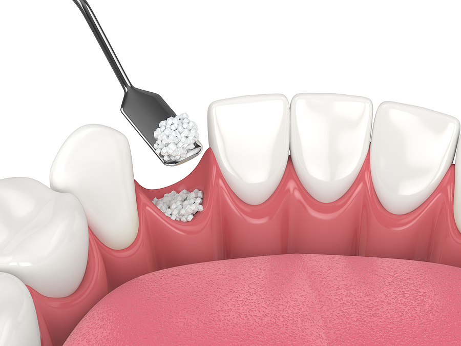 Bone Grafting: Restoring Jaw Strength for Dental Implants in Hattiesburg, MS, and Laurel, MS