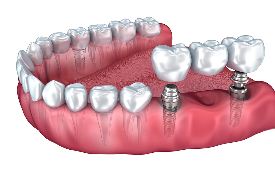 Restore Your Smile with Dental Implants in Hattiesburg, MS, and Laurel, MS