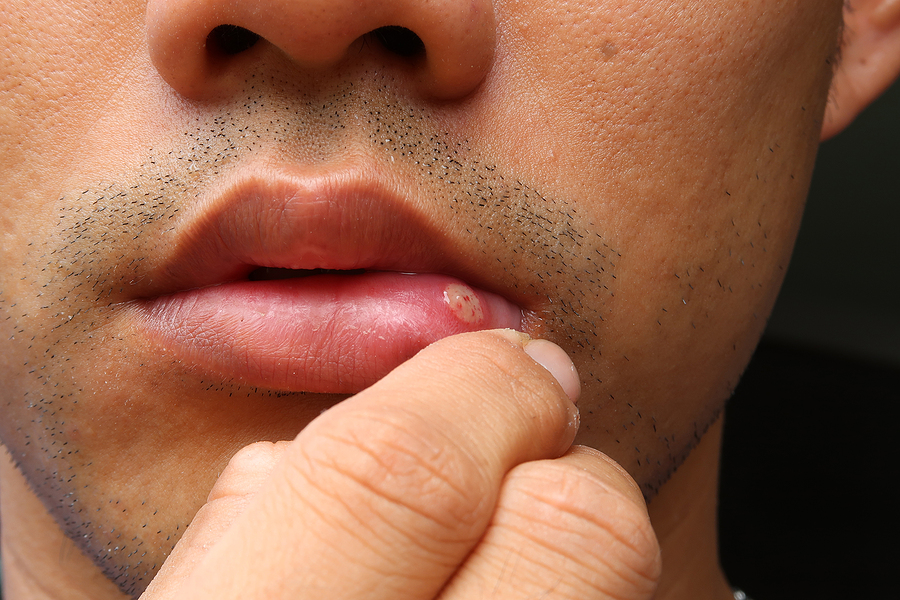 Comprehensive Management of Oral Lesions in Hattiesburg, MS, and Laurel, MS