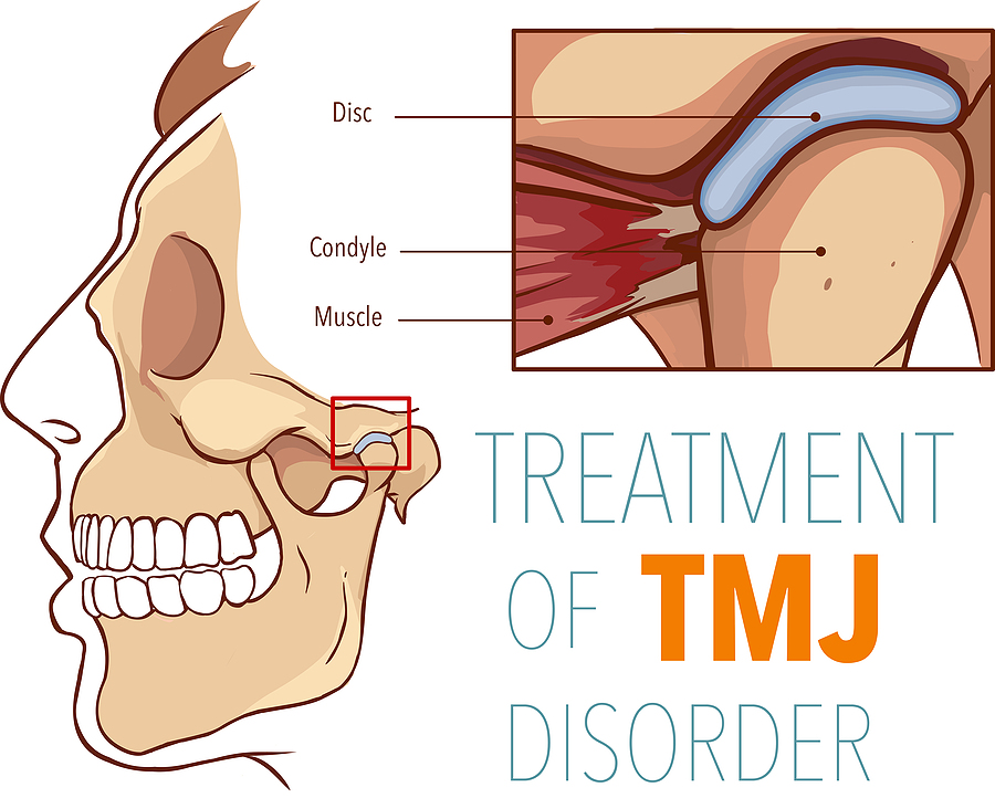Effective TMJ Therapy in Hattiesburg, MS, and Laurel, MS: Relieve Jaw Pain and Restore Function